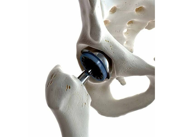 Hip Replacement Recovery: Q&A with a Hip Specialist